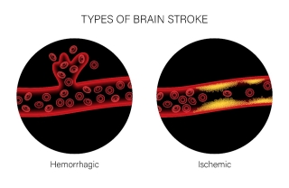 Types of Brain Strokes Types of Brain Strokes