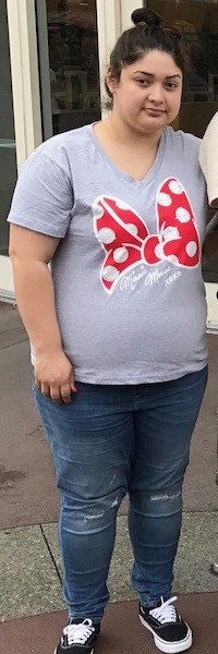 Before image of weight loss surgery Before image of weight loss surgery